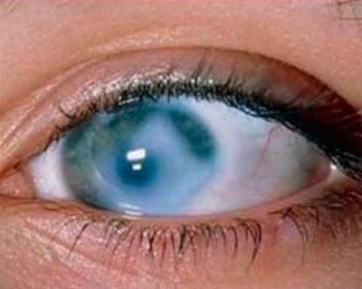 Как предотвратить возникновение глаукомы?