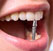 Методы восстановления зубов: протезирование или имплантация – что лучше